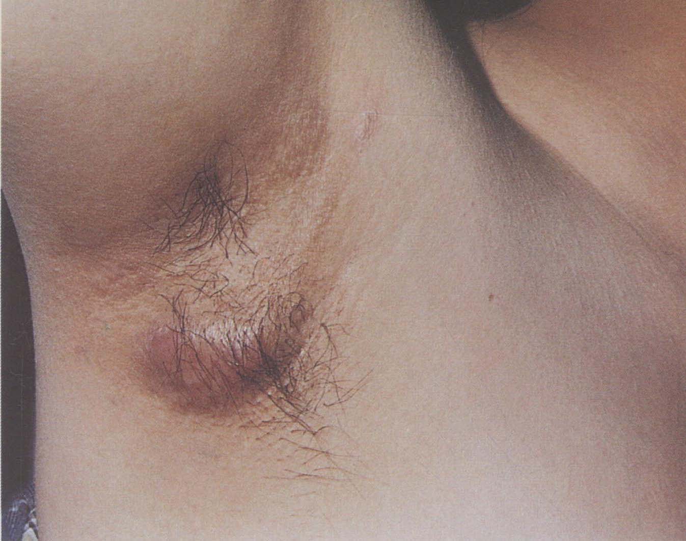 化膿性汗腺炎